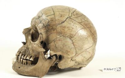 Schedel in Israël gevonden die 3.500 jaar oude hersenoperatie aantoont